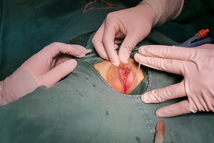 会阴型的尿道下裂症状图