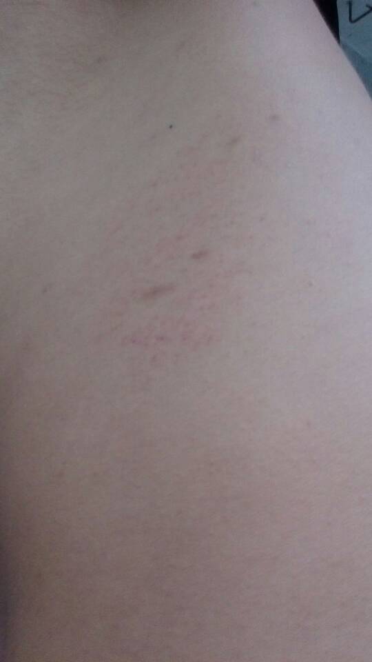 侧腰位置的红色瘀斑是怎么回事?是不是睡觉压到的,还是怎么了,给分