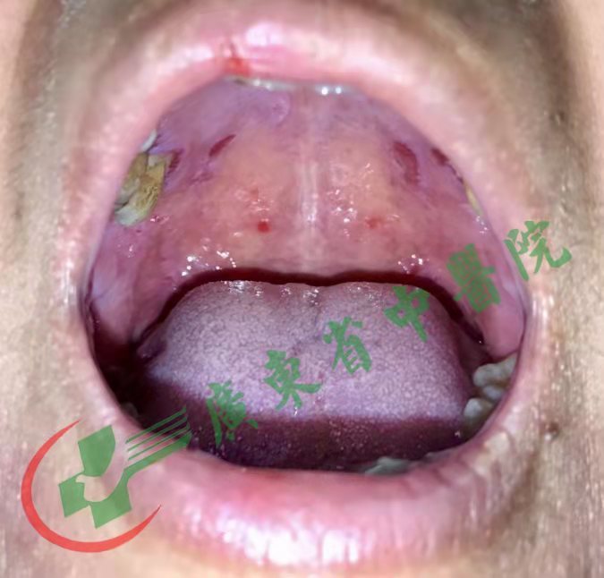 不容忽视的"疱"——天疱疮,类天疱疮(免疫性大疱性皮肤病)介绍_天疱疮