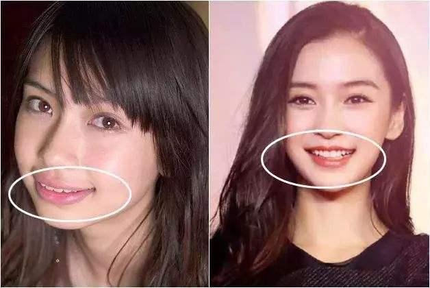 牙齿矫正不但能让牙齿变整齐,还能改变一个人的脸型,以及改善凸嘴