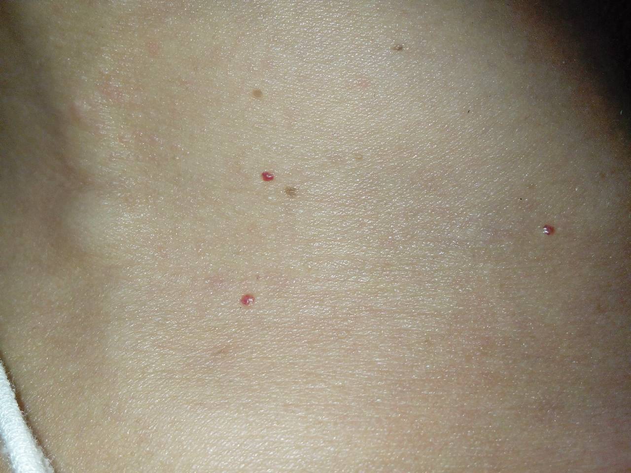 去年开始,我脖子周围长了好几颗红点,不痛也不痒,我女儿右肩上也长