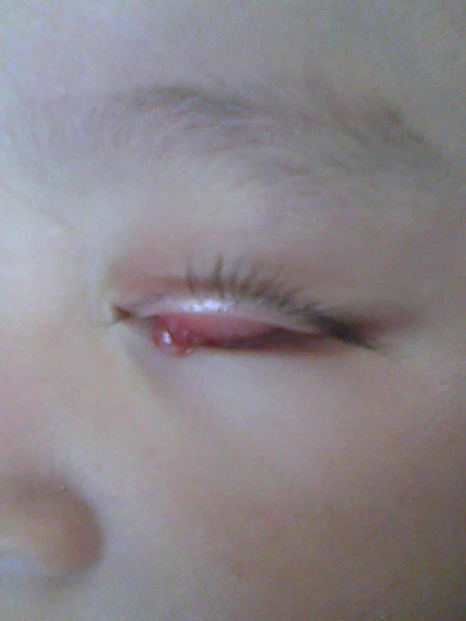 宝宝左眼上眼睑内有霰粒肿苏州儿童医院医生说需要手术刮除请做过此