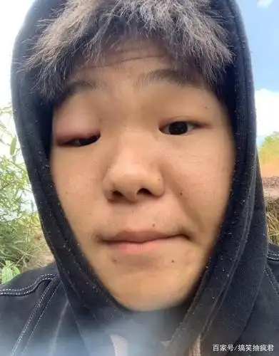 蜜蜂蜇眼睛搞笑图片