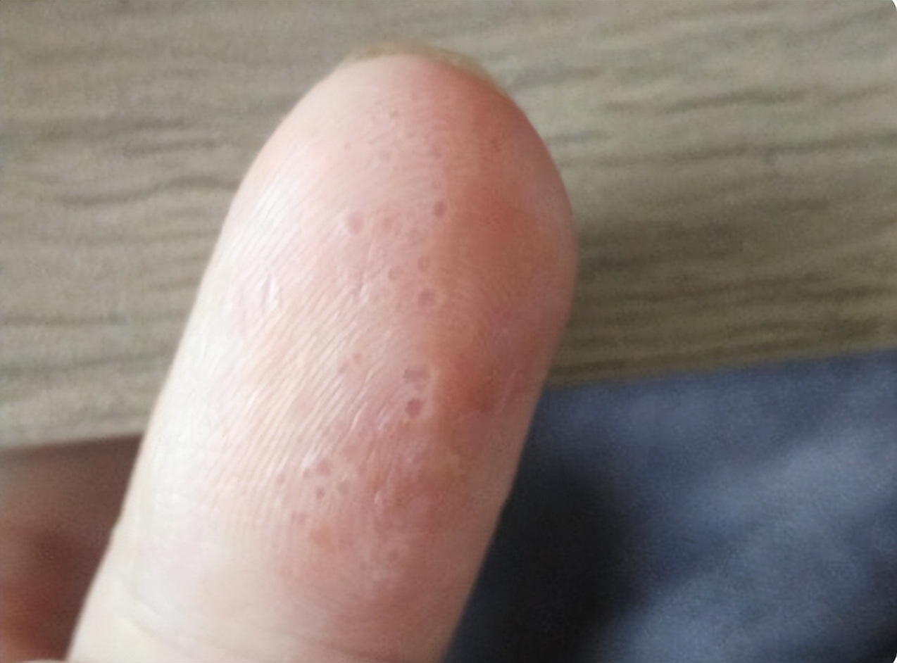 03,如何预防汗疱疹?