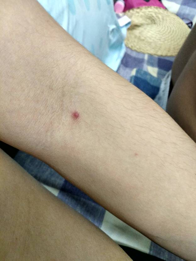 手肘内侧长了一个像痘痘的东西,不痒按下有少少痛,一个星期了不知道是