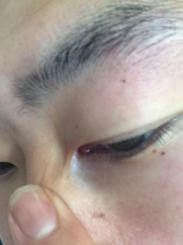 问:眼角里面长个肉疙瘩这有问题