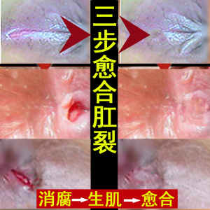 【三件套】肛裂特效愈合膏成人儿童宝宝便出血瘙痒生肌外用药膏