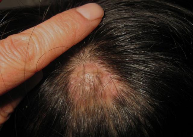 为什么头皮经常长脓包和疙瘩?医生暗示:3种病或要考虑其中