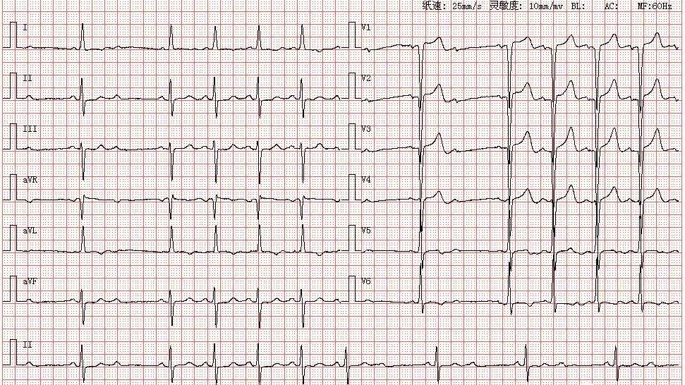 心电图图库丨二度ii型(2:1)房室传导阻滞系列 - 知乎