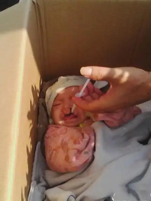 [转贴]裂唇的婴儿遭狠心妈妈遗弃,继小悦悦后又一人间的悲剧!