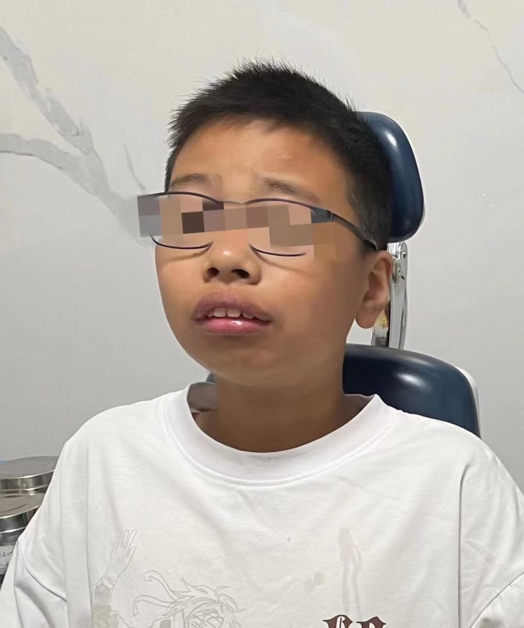 爸妈很后悔-12岁儿子腺样体面容92 【暑期学生就诊高峰期】 今天