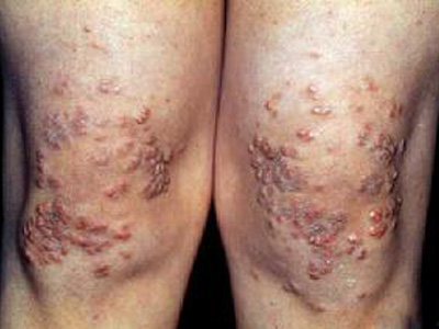 非典型纤维黄色瘤表现为结节状或溃疡的肿物,一般体积较小且位置表浅