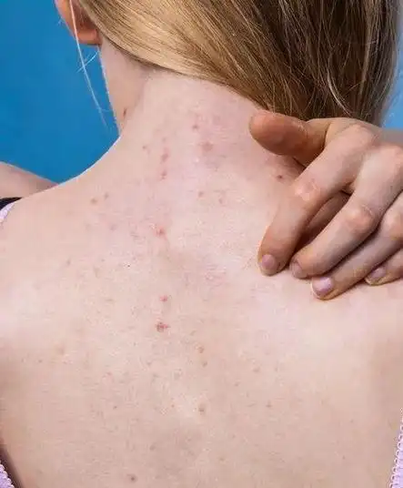 梅毒疹图片(梅毒疹图片 初期 发生)-生活常识-江湖救急网