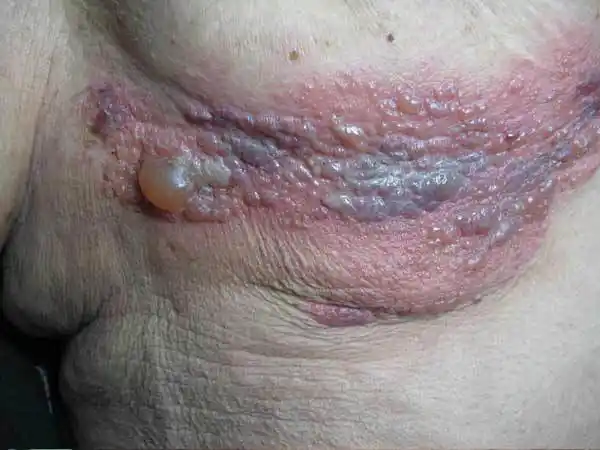 带状疱疹患者饮食护理措施是什么