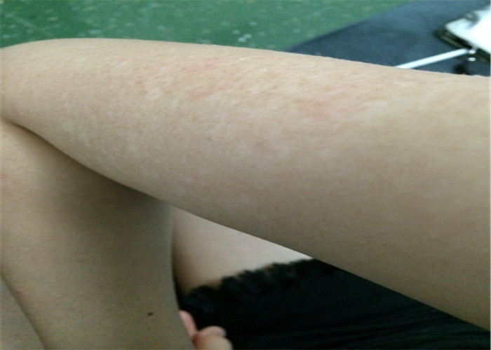 花斑癣头部脱毛症状图片