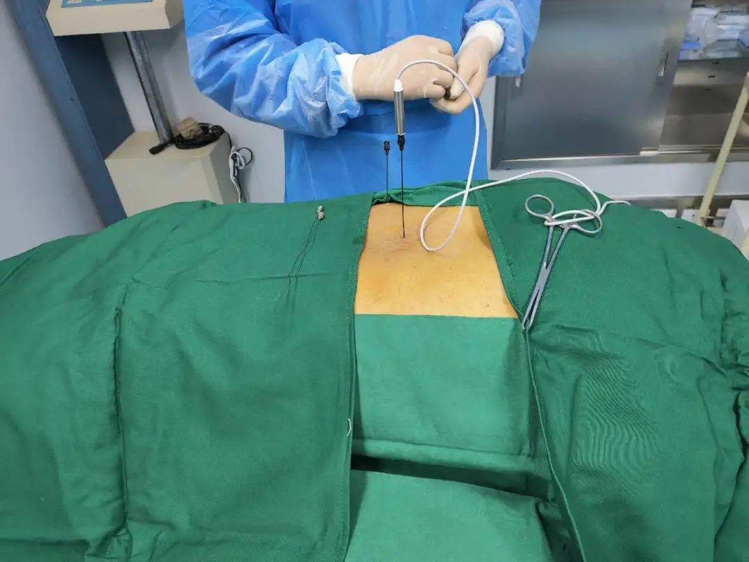 射频消融术不开刀治疗难缠腰椎间盘突出症