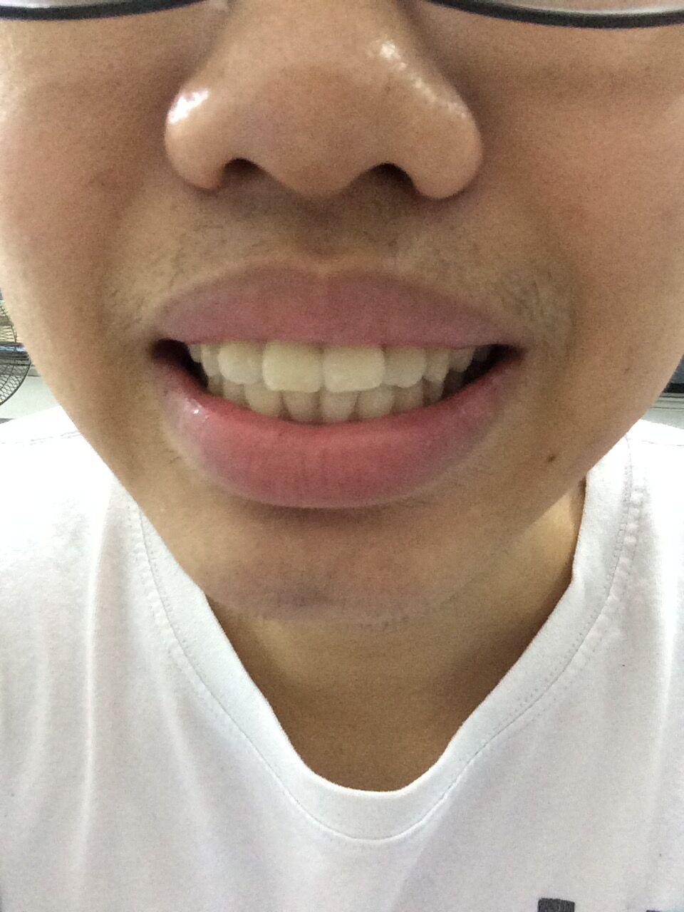 (照片)牙齿前突,想纠正,门牙大,牙缝小,请问怎么办?