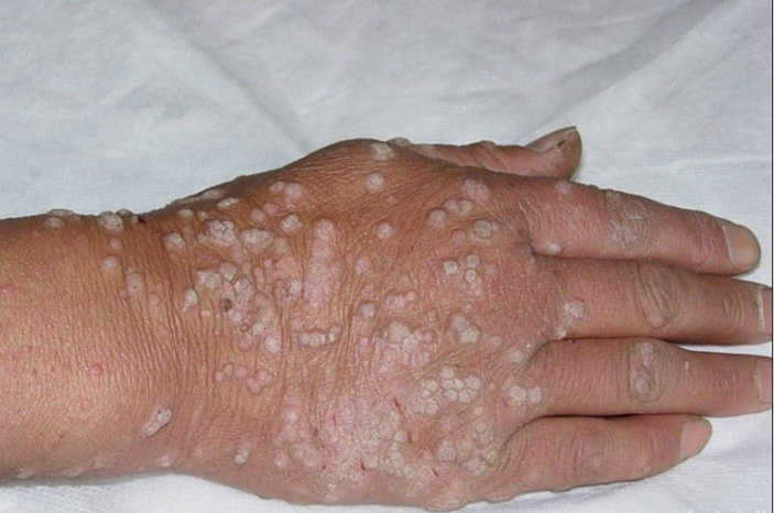 寻常疣图片症状手