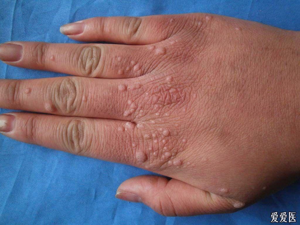 典型病例:寻常疣. - 皮肤及性传播疾病讨论版 - 爱爱医医学论坛