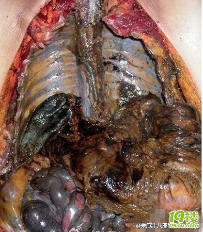 ===抽烟的肺,就是这样的