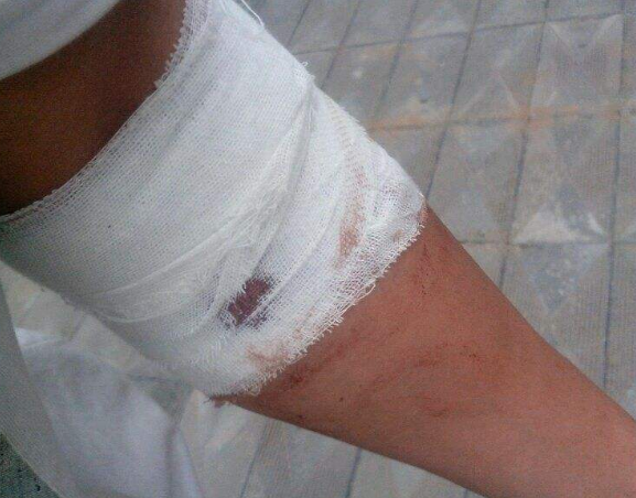 胳膊流血真实图片53