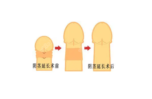 男人阴茎延长术前后对比图