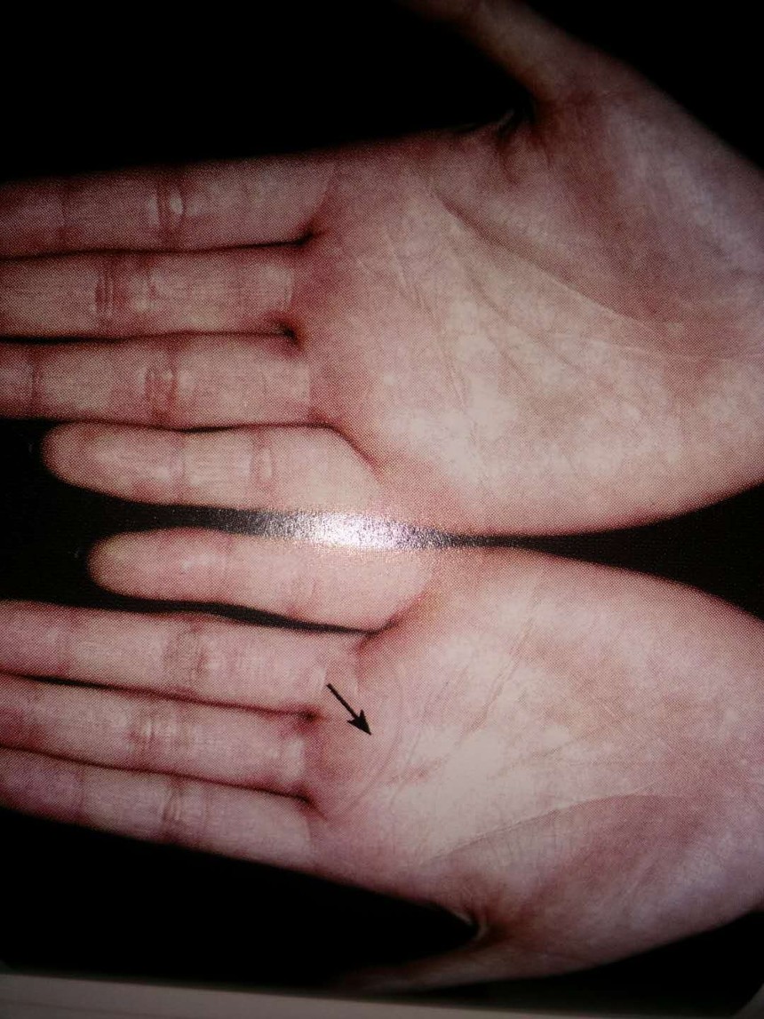 风水玄学  手相掌纹 9线对诊断肿瘤有什么特殊意义科研征实癌症与环境