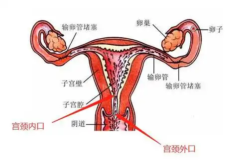宫颈松 子宫颈托 经阴环扎 腹扎哪个能胜过安太环?