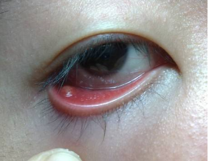 眼睛麦粒肿初期图片7