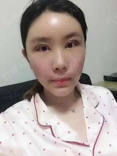 自体脂肪面部填充术后7天_眼综合整形术后7天_面部填充术后7天_眼型