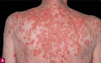 落叶型天疱疮pemphigusfoliaceus