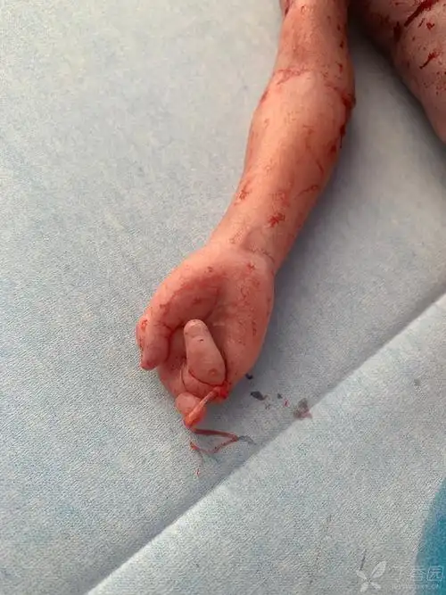 羊膜带缠绕引起胎儿畸形