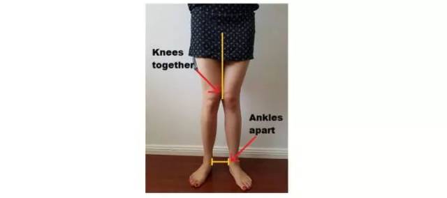超级科普膝盖内扣knockknees连载一二