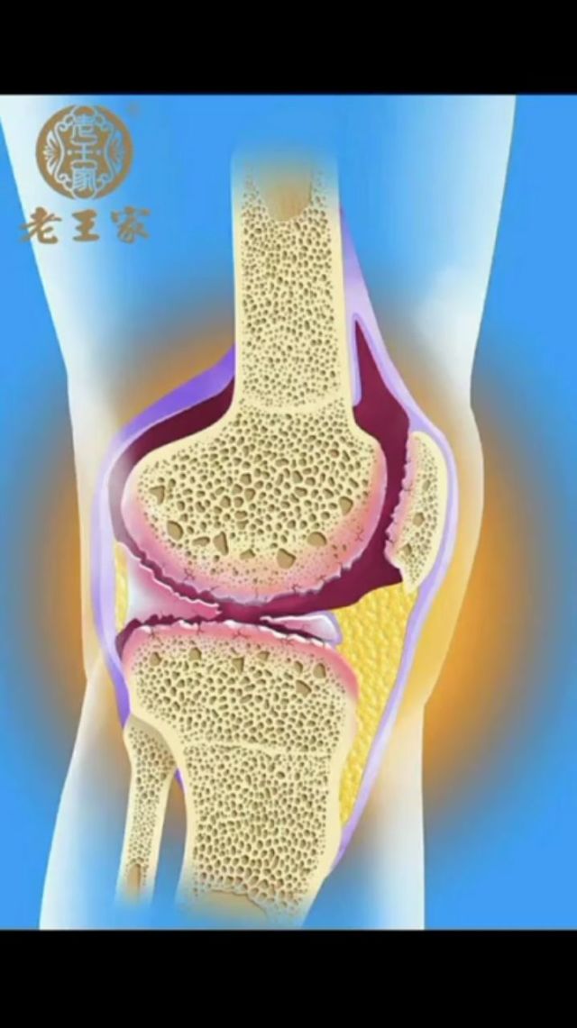 【90,骨病知识~滑膜炎】膝关节滑膜炎是一种无菌型炎症,是由于膝