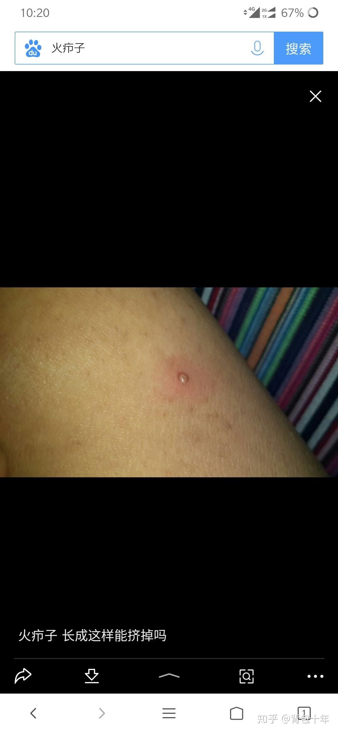 事后过去的一个月,安安稳稳度过!我感觉这东西就是个普通疙瘩发炎了!