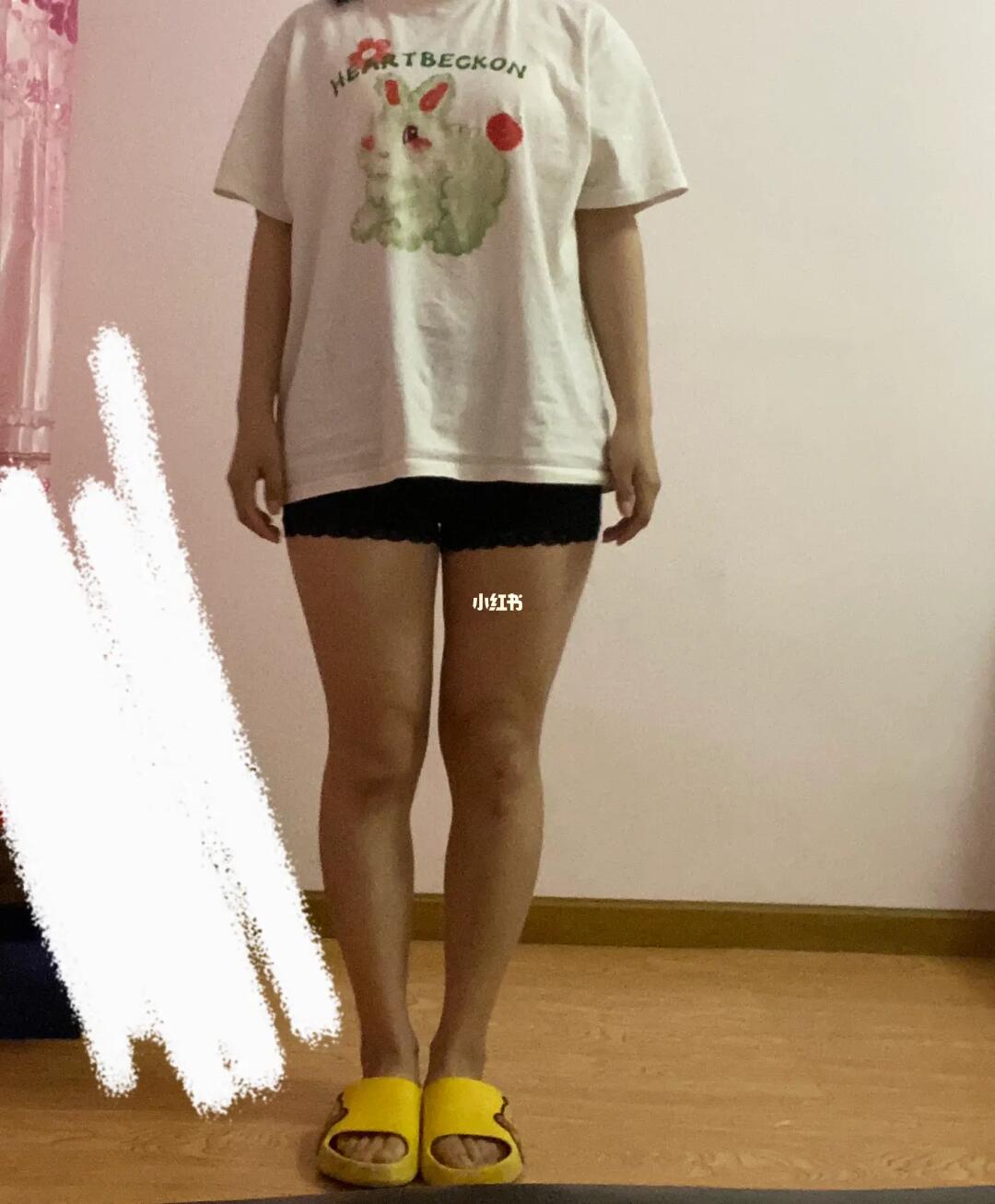 腿弯成这样还有救吗