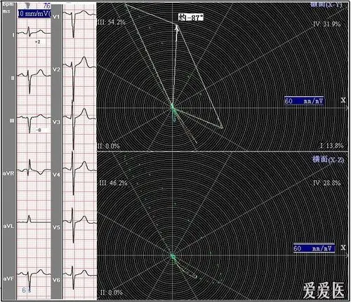 看图学心电02心电轴测量