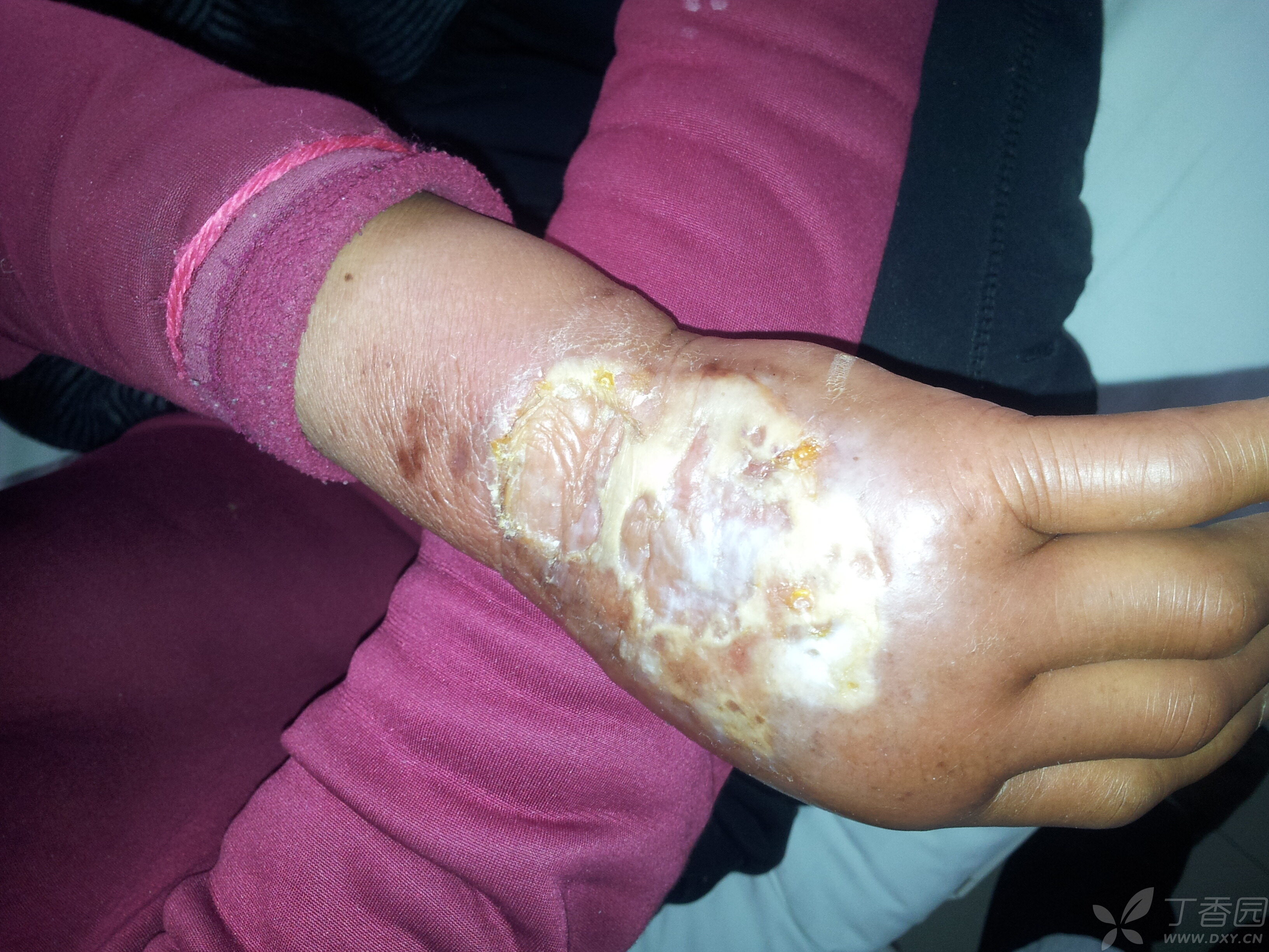 【请教】盐酸表柔比星外渗引起皮肤损害的求助