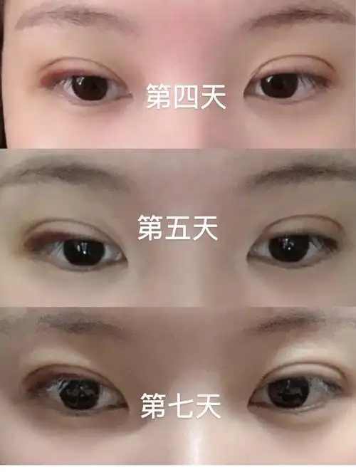 埋线双眼皮10天图