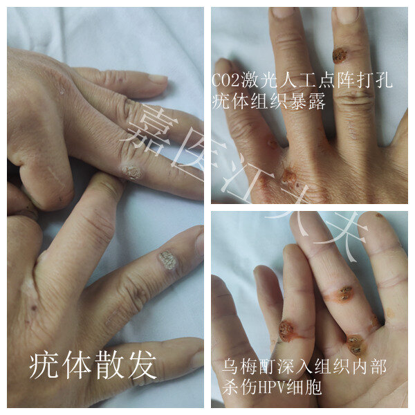 co2点阵激光结合中药治疗病毒疣