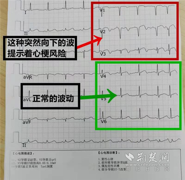 "心电图上v1-v3的波浪线提示着心脏前间壁的健康状况.