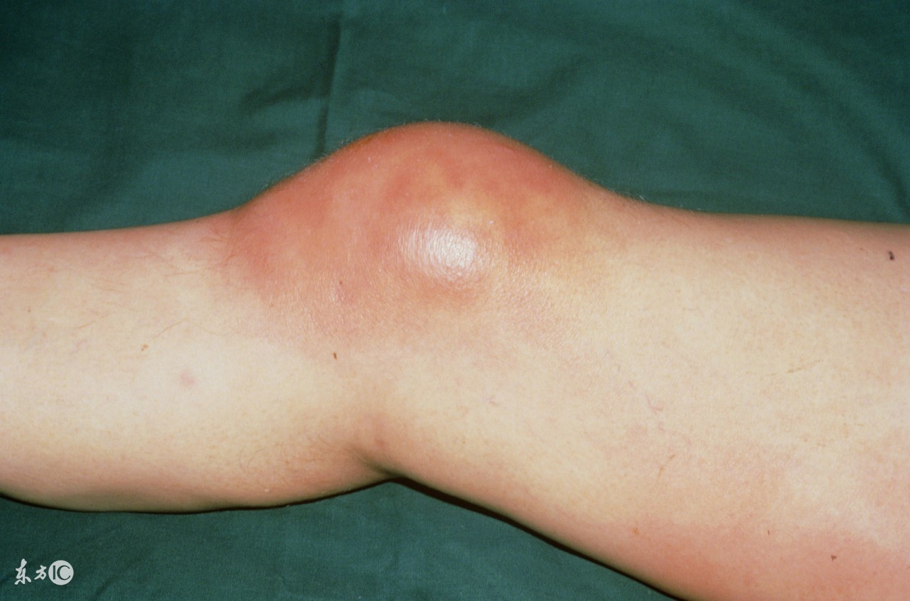 滑膜炎要怎么治疗?听听骨科医生怎么说