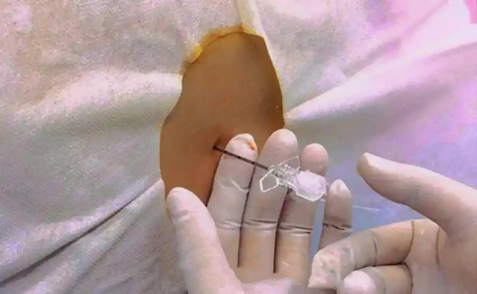 好吧,感同身受,跟个风!熬过插尿管,上过手术台,挺住了10厘 - 抖音