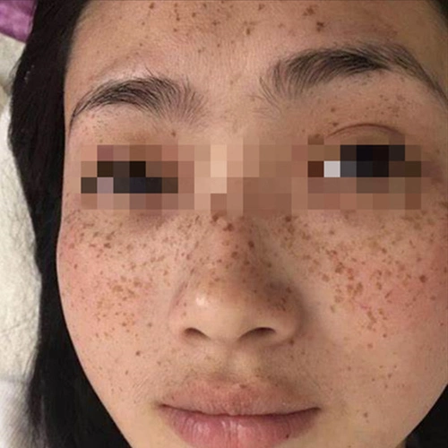 斑点怎么回事脸上突然长斑