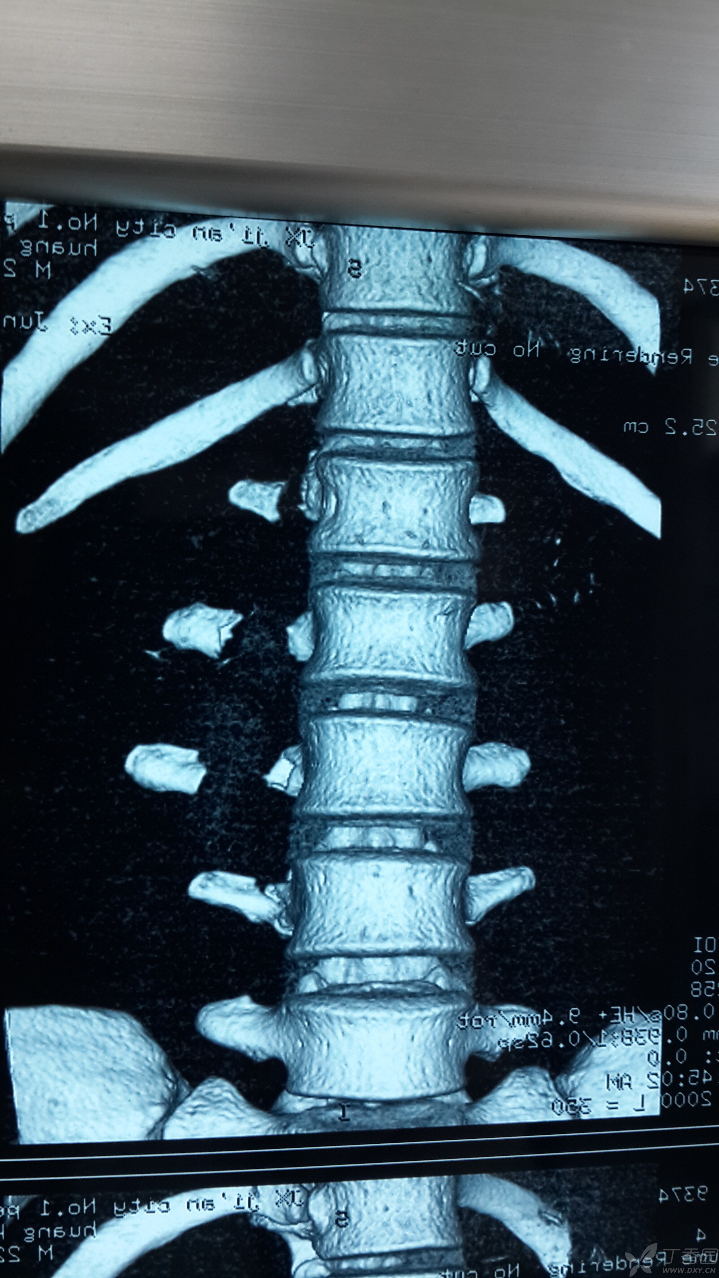 多发腰椎横突骨折一例,需要手术吗