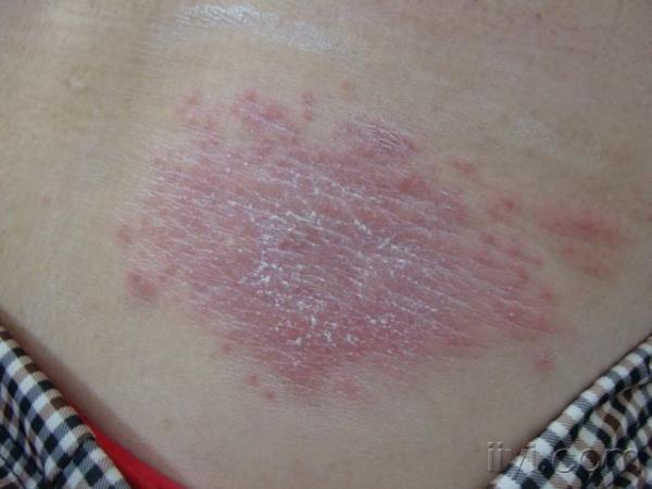 背部红斑丘疹 - 皮肤及性传播疾病讨论版 - 爱爱医医学论坛 - 爱爱医
