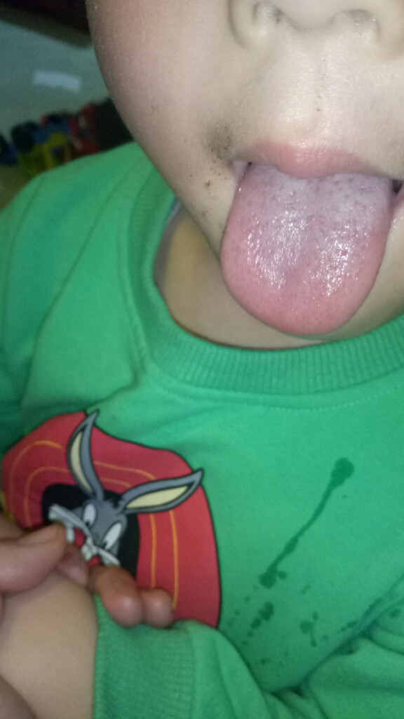 宝宝舌苔白且厚,怎么办