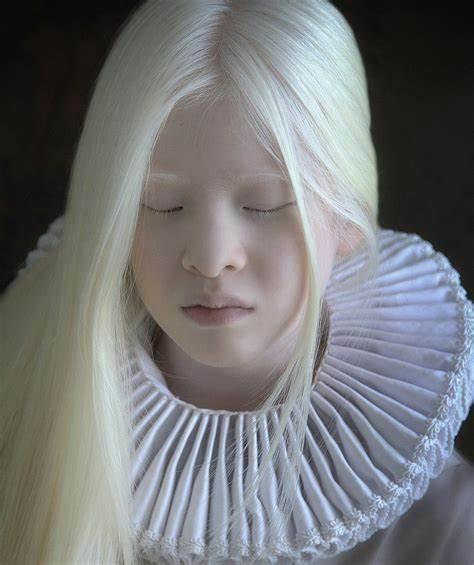 亚洲人?白化病弃儿在荷兰开启全新的精彩人生