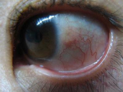 青光眼失明后眼睛为什么会出现视物感觉