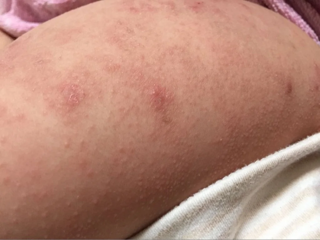 宝贝身上起东西 全身都是 跟癣一样 有没有医生帮我看看这是什么东西